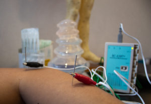 Acupuncture Dry Needling Tottenham